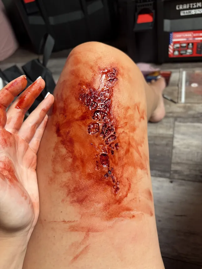 Burn Trauma