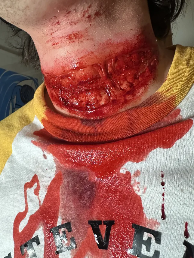 Neck Injury