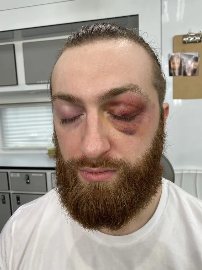 Bruised, Beat-up, & Bloody