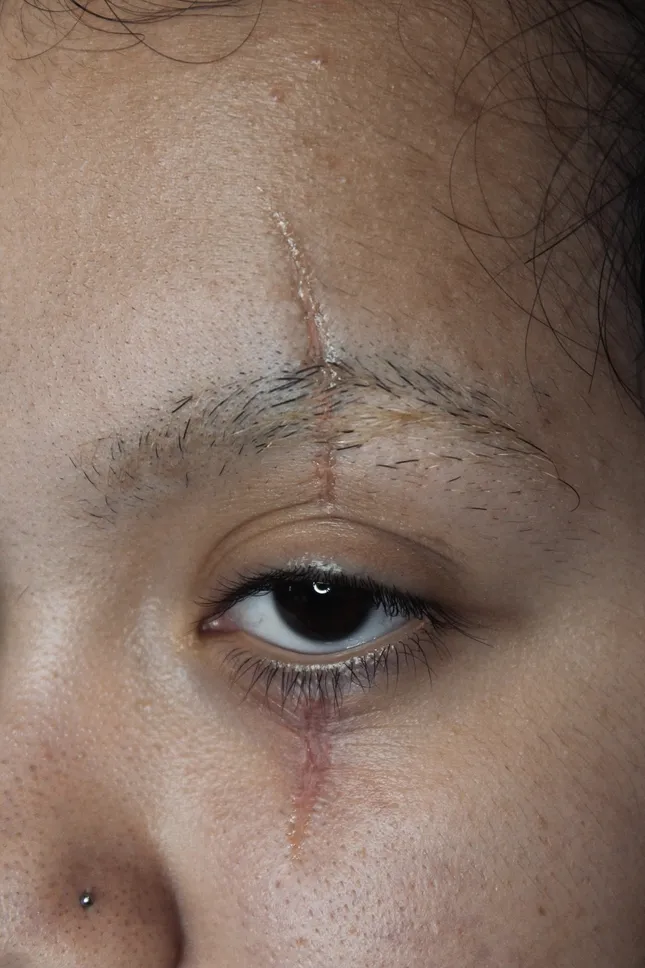 Eye Scar - SFX