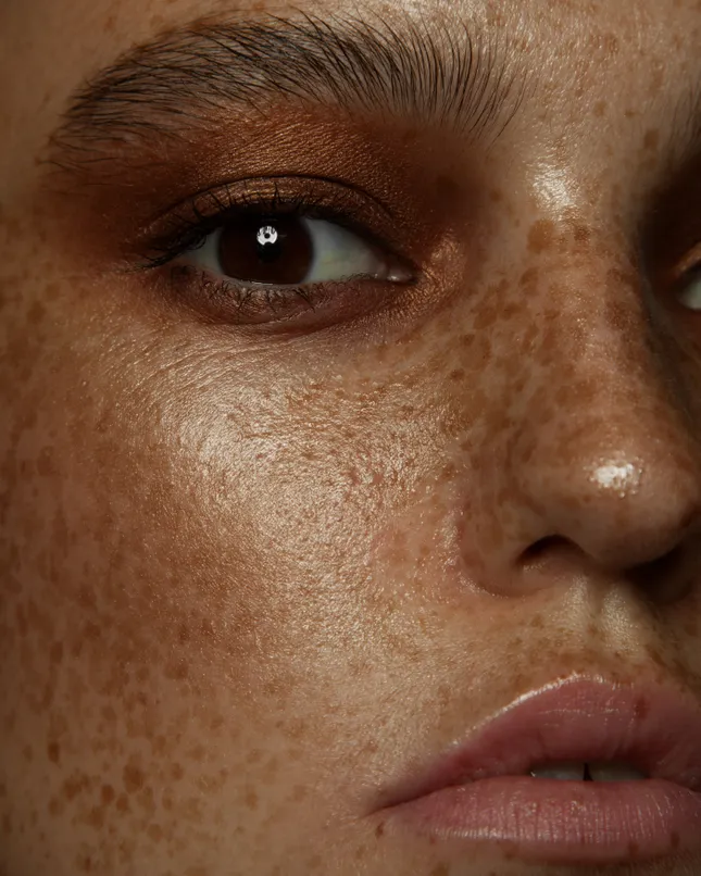 Freckles