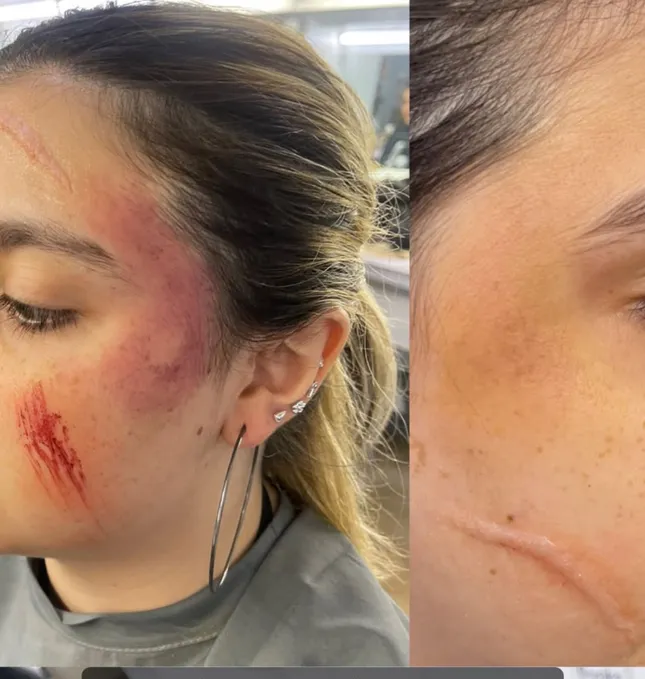Sfx cuts and bruises