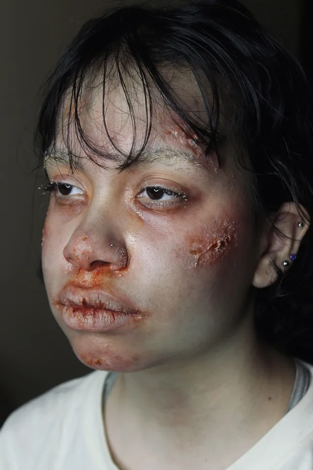 Mild Frostbite - SFX