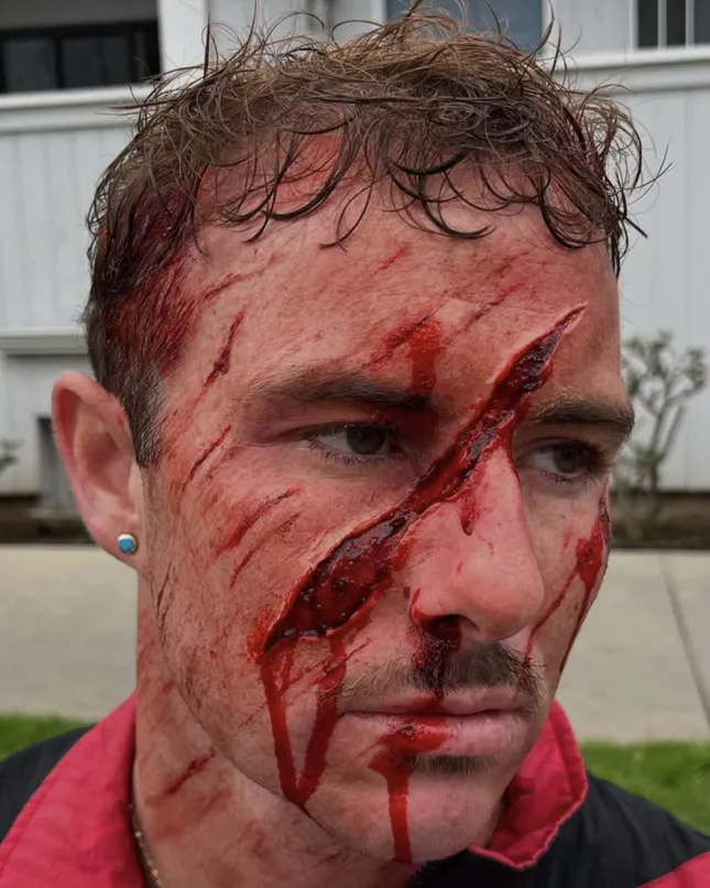 Facial Injuries
