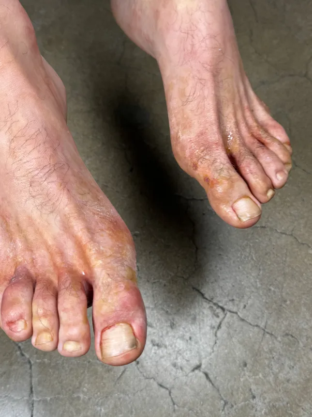 Severe Athletes foot