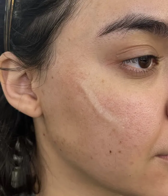 Keloid Scar