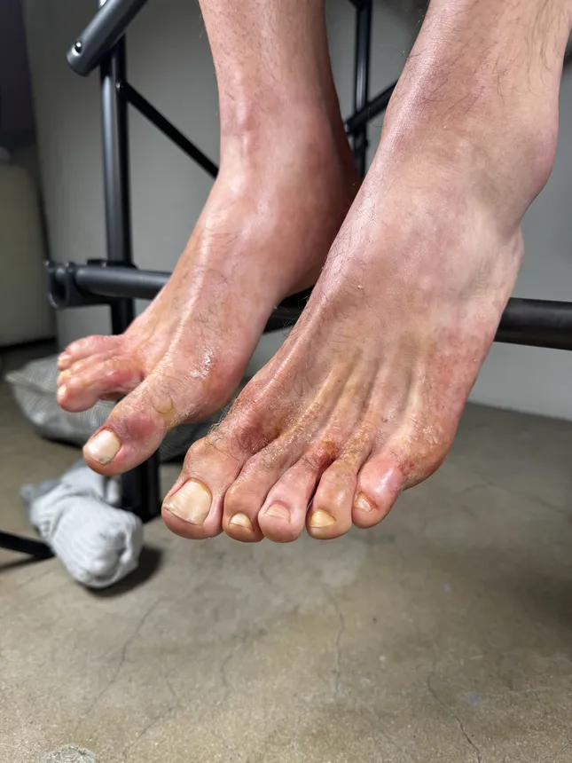 Severe Athlete's Foot