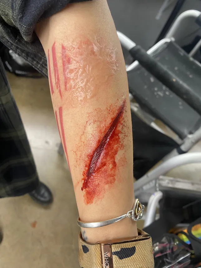 Various examples of wounds
