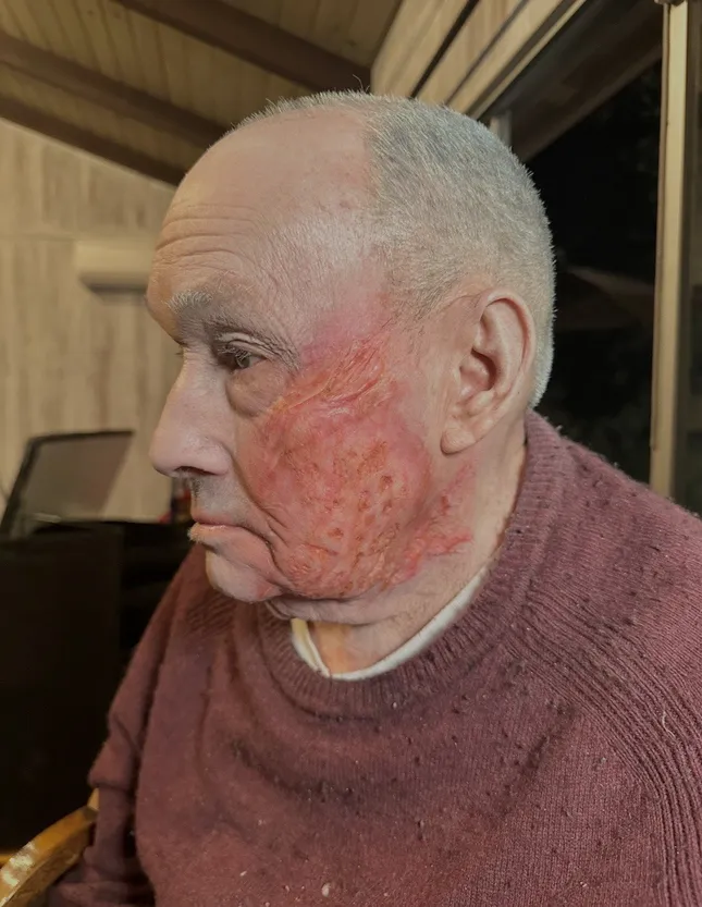 Burn Injury
